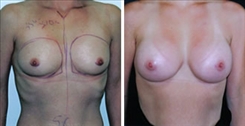 Breast Augmentation Patient Before & After Photo 1