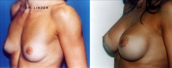 Breast Procedures Patient Before & After Photo 1