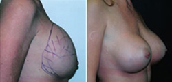 Breast Implant Revision