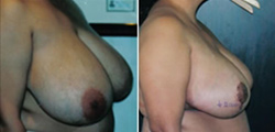 Breast Reduction