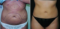 Liposuction