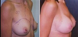 Pectus Carinatum Breast