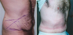 Tummy Tuck for Men