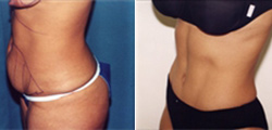 Tummy Tuck