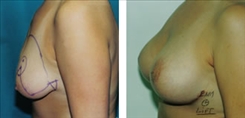 Breast Lift Patient Before & After Photo 1