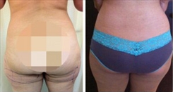 Muffin Bottom Patient Before & After Photo 1