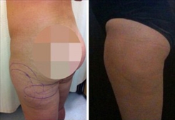 Muffin Bottom Patient Before & After Photo 1