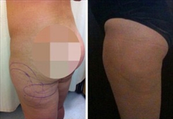 Body Procedures Patient Before & After Photo 1