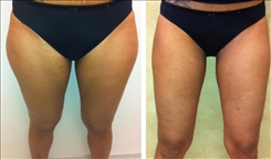 Saddlebag / Thigh Patient Before & After Photo 1