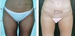 Saddlebag / Thigh Patient Before & After Photo 1