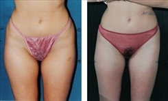 Saddlebag / Thigh Patient Before & After Photo 1