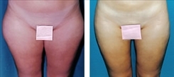 Saddlebag / Thigh Patient Before & After Photo 1