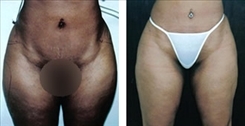 Saddlebag / Thigh Patient Before & After Photo 1