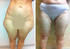 Saddlebag / Thigh Patient Before & After Photo 1