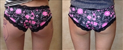 Saddlebag / Thigh Patient Before & After Photo 1