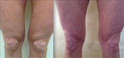 Knob Knee Patient Before & After Photo 1