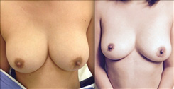 Breast Procedures Patient Before & After Photo 1