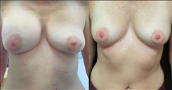 Implant Removal Patient Before & After Photo 1