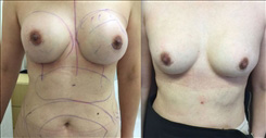 Breast Procedures Patient Before & After Photo 1