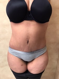 4 Weeks Post Op