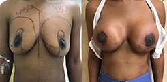 African American Breast Implants Patient Before & After Photo 1