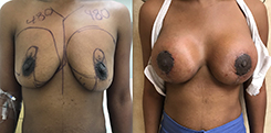 Breast Procedures Patient Before & After Photo 1