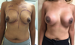 Breast Procedures Patient Before & After Photo 1