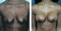 African American Breast Implants Patient Before & After Photo 1