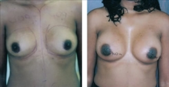 African American Breast Implants Patient Before & After Photo 1