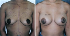 African American Breast Implants Patient Before & After Photo 1