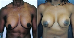 African American Breast Implants Patient Before & After Photo 1