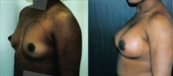 African American Breast Implants Patient Before & After Photo 1