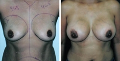 African American Breast Implants Patient Before & After Photo 1