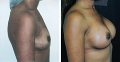 African American Breast Implants Patient Before & After Photo 1