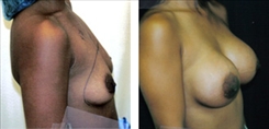 African American Breast Implants Patient Before & After Photo 1