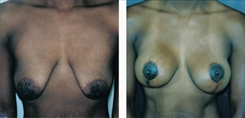 African American Breast Implants Patient Before & After Photo 1