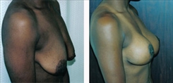 African American Breast Implants Patient Before & After Photo 1