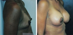 African American Breast Implants Patient Before & After Photo 1