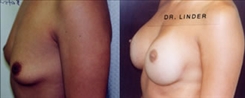 African American Breast Implants Patient Before & After Photo 1