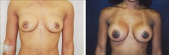 African American Breast Implants Patient Before & After Photo 1