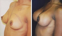 African American Breast Implants Patient Before & After Photo 1