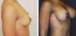 African American Breast Implants Patient Before & After Photo 1