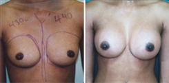 African American Breast Implants Patient Before & After Photo 1