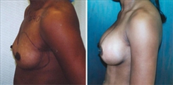 African American Breast Implants Patient Before & After Photo 1