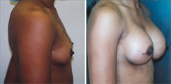 African American Breast Implants Patient Before & After Photo 1