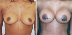 African American Breast Implants Patient Before & After Photo 1