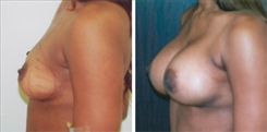 African American Breast Implants Patient Before & After Photo 1