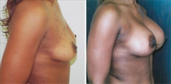 African American Breast Implants Patient Before & After Photo 1