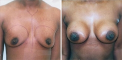 African American Breast Implants Patient Before & After Photo 1