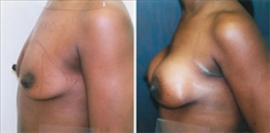 African American Breast Implants Patient Before & After Photo 1